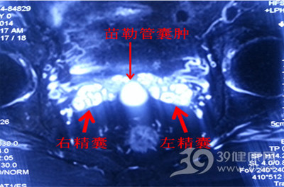 醫技微型睛變明 空軍總醫院泌尿外科精囊鏡技術精準診治血精回顧